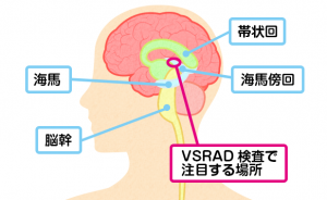 VSRAD検査で注目する場所